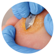 Hard skin removal