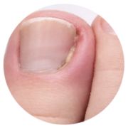 Ingrown toenails