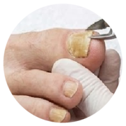 Thickened nails