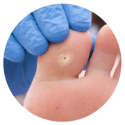 Verruca treatment